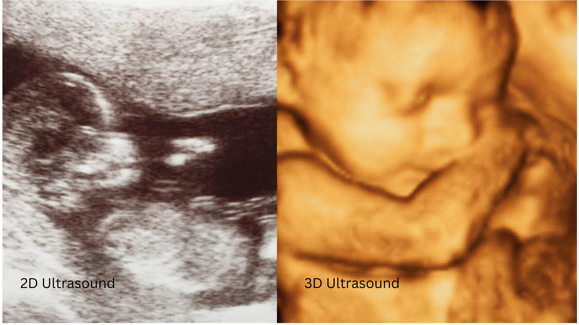 What is a 3D ultrasound and how does it work Best pregnancy care