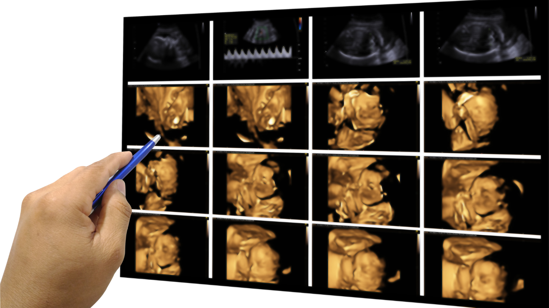 What is a 3D ultrasound and how does it work Best pregnancy care